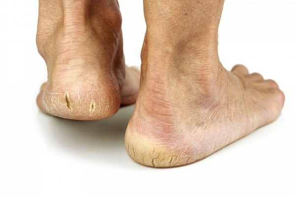 cracked feet 